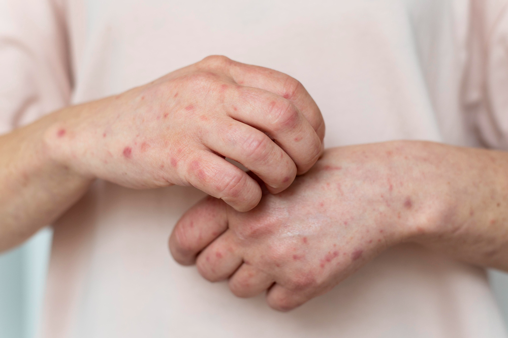 Prakaitinis bėrimas: kada kreiptis į gydytoją